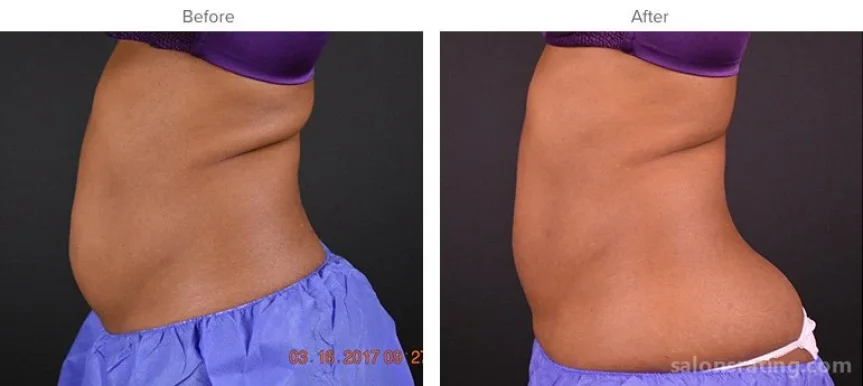 Keller Aesthetic Specialists CoolSculpting & SculpSure, Sandy Springs - Photo 8