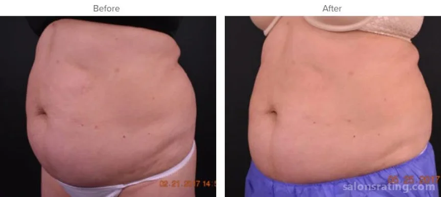Keller Aesthetic Specialists CoolSculpting & SculpSure, Sandy Springs - Photo 3