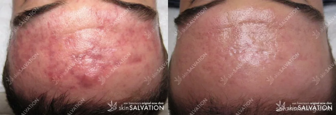 SkinSALVATION acne clinic, San Francisco - Photo 5