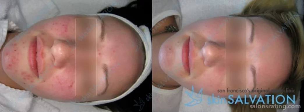 SkinSALVATION acne clinic, San Francisco - Photo 6