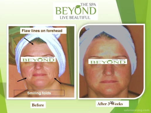 BEYOND THE SPA #1 ~ HIFU-Ultherapy Face-Neck Lift for Lower Session Trial: $499.00 ~, San Jose - Photo 4