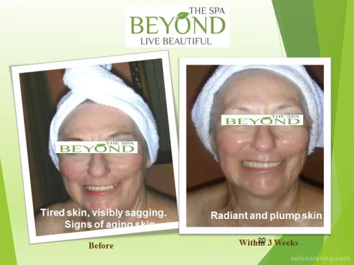 BEYOND THE SPA #1 ~ HIFU-Ultherapy Face-Neck Lift for Lower Session Trial: $499.00 ~, San Jose - Photo 5