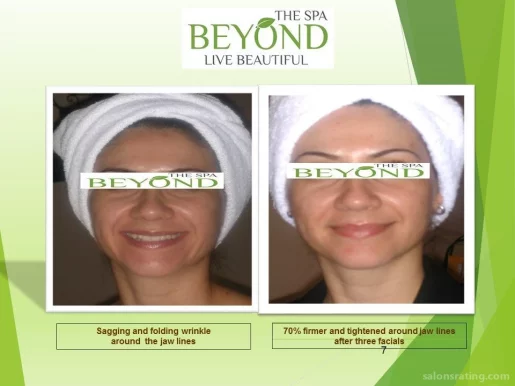 BEYOND THE SPA #1 ~ HIFU-Ultherapy Face-Neck Lift for Lower Session Trial: $499.00 ~, San Jose - Photo 3