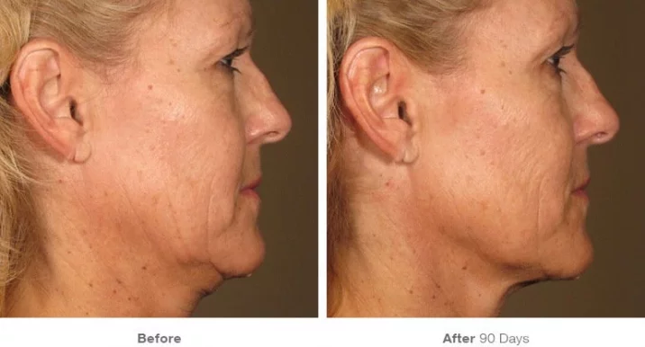 BEYOND THE SPA #1 ~ HIFU-Ultherapy Face-Neck Lift for Lower Session Trial: $499.00 ~, San Jose - Photo 6