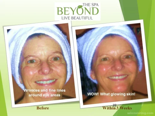 BEYOND THE SPA #1 ~ HIFU-Ultherapy Face-Neck Lift for Lower Session Trial: $499.00 ~, San Jose - Photo 7