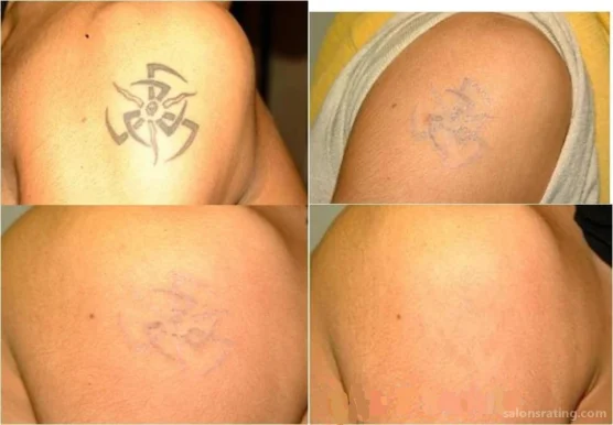 ZAP that TATT Laser Tattoo Removal Santa Clarita, Santa Clarita - Photo 2