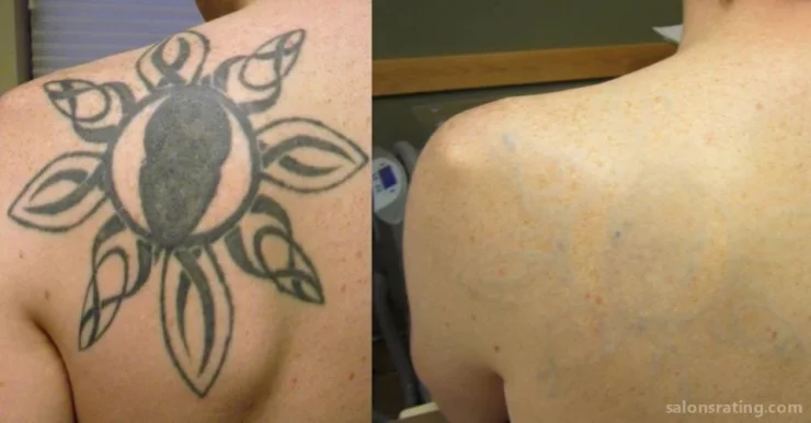 Blink Tattoo Removal, Seattle - Photo 1