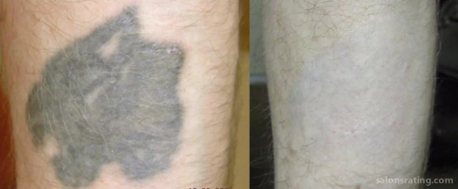 Blink Tattoo Removal, Seattle - Photo 7