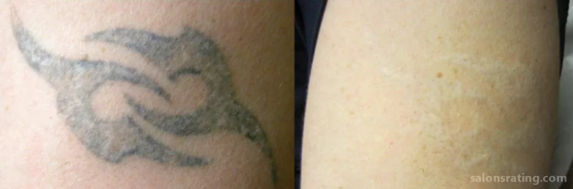 Blink Tattoo Removal, Seattle - Photo 4