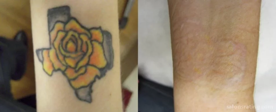 Blink Tattoo Removal, Seattle - Photo 6