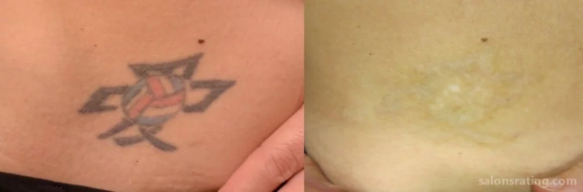 Blink Tattoo Removal, Seattle - Photo 5