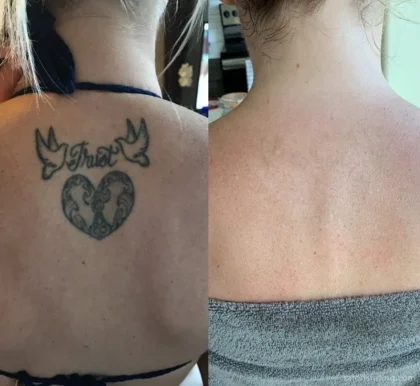 Removery Tattoo Removal & Fading, Tampa - Photo 3